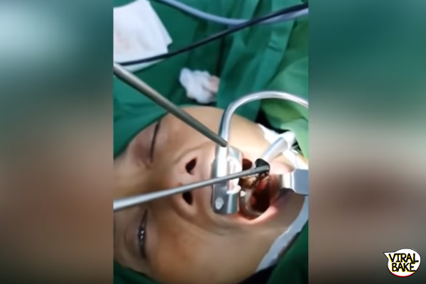 doctors removing two-inch live leech 