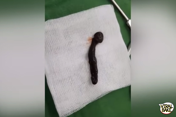 doctors removing two-inch live leech
