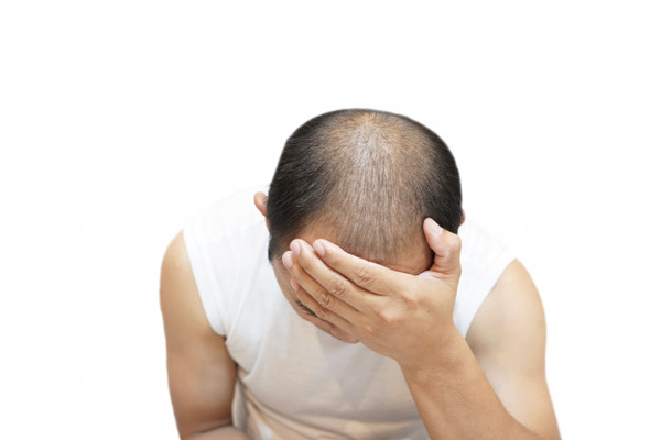 prevent baldness