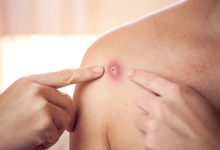 Monkeypox, Know How Long Symptoms Lasts, Precautions