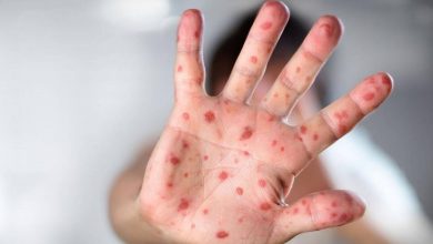 4 Monkeypox Cases In India, Symptoms, Prevention, And More