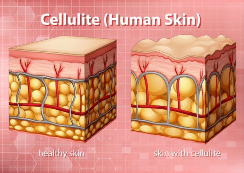Did you know there is juice for every illness: Cellulite