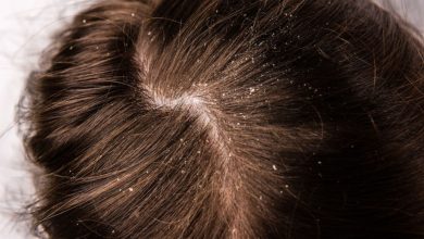 3 Natural Ways to Get Rid of Dandruff in your Hair